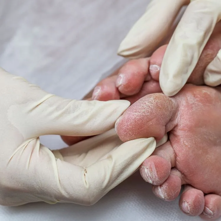 Piede diabetico: i segnali che molte persone ignorano