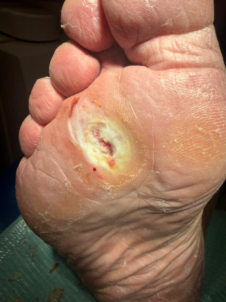 Piede diabetico