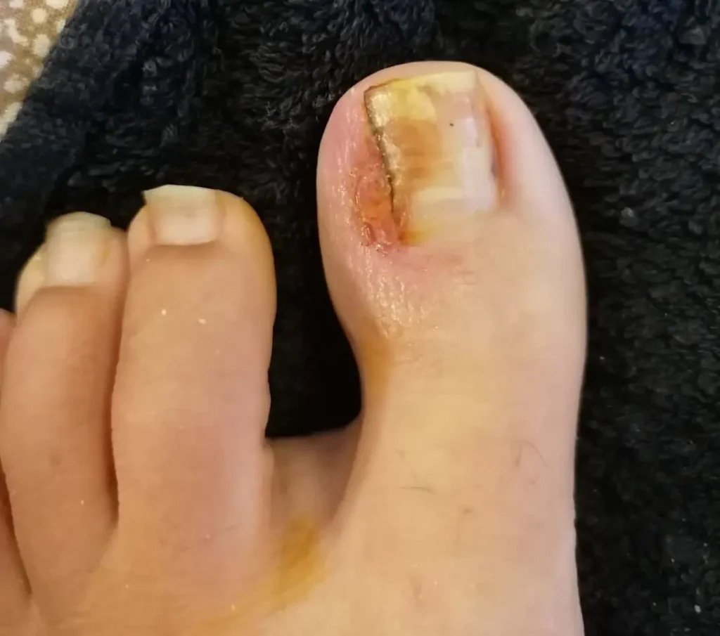 Fenolizzazione Ungueale​
