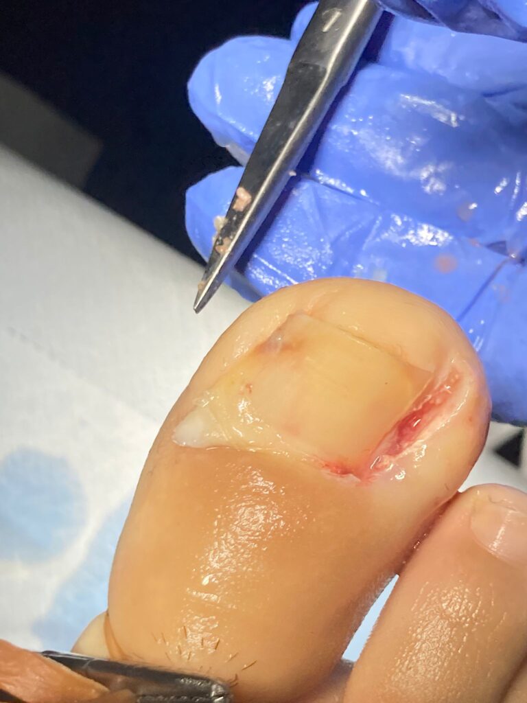Fenolizzazione Ungueale​
